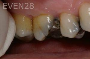 David-Sturgeon-Dental-Crown-before-3