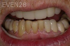 David-Sturgeon-Dental-Crown-before-4