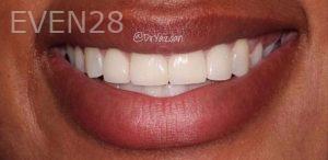 Desiree-Yazdanshenas-Dental-Crowns-after-1