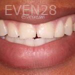 Desiree-Yazdanshenas-Dental-Crowns-before-1