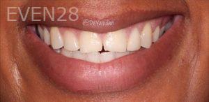 Desiree-Yazdanshenas-Dental-Crowns-before-1