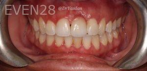 Desiree-Yazdanshenas-Dental-Implants-after-1