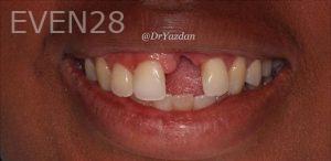 Desiree-Yazdanshenas-Dental-Implants-before-1