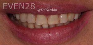 Desiree-Yazdanshenas-Full-Mouth-Rehabilitation-before-2
