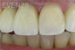 Diane-Conly-Dental-Crowns-after-1