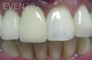 Diane-Conly-Dental-Crowns-before-1