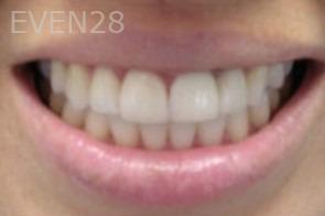Diane-Conly-Porcelain-Veneers-after-1