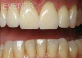 Diane-Conly-Porcelain-Veneers-after-2