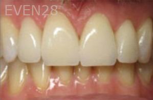 Diane-Conly-Porcelain-Veneers-after-3