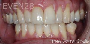 Dino-Gharibian-Dental-Crowns-after-1
