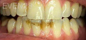 Faraz-Farahnik-Teeth-Whitening-before-1