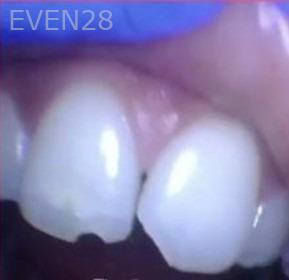 Francine-Jackson-Dental-Bonding-before-2