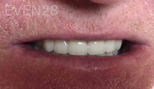 Francine-Jackson-Dentures-after-4