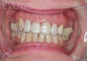 Gurgen-Sahakyan-Dental-Crowns-after-2b