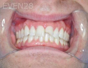 Gurgen-Sahakyan-Dental-Crowns-before-1b