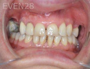 Gurgen-Sahakyan-Dental-Crowns-before-2b