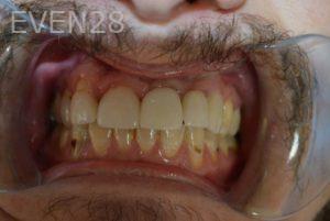 Gurgen-Sahakyan-Dental-Implants-after-1b