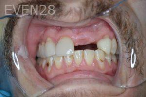 Gurgen-Sahakyan-Dental-Implants-before-1b