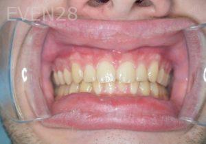 Gurgen-Sahakyan-Orthodontic-Braces-after-1b