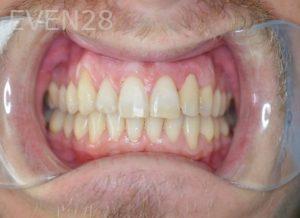 Gurgen-Sahakyan-Orthodontic-Braces-after-2b