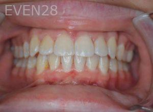 Gurgen-Sahakyan-Orthodontic-Braces-after-3