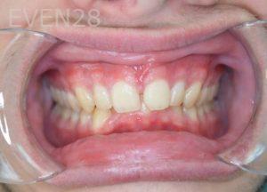 Gurgen-Sahakyan-Orthodontic-Braces-before-1b