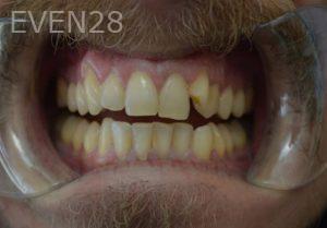 Gurgen-Sahakyan-Orthodontic-Braces-before-2b