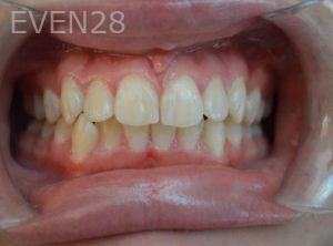 Gurgen-Sahakyan-Orthodontic-Braces-before-3