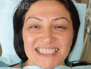 Gurgen-Sahakyan-Smile-Makeover-before-2
