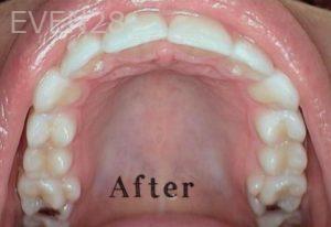 Heather-Winther-Invisalign-Clear-Aligners-after-4