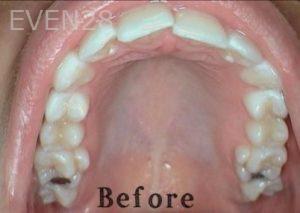 Heather-Winther-Invisalign-Clear-Aligners-before-4