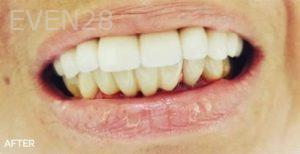 Jae-Lee-Teeth-Dental-Crowns-after-1
