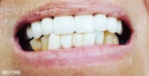 Jae-Lee-Teeth-Dental-Crowns-before-1