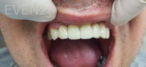 Jae-Lee-Teeth-Dental-Implants-after-1