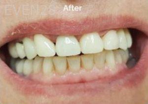 Jae-Lee-Teeth-Dental-Implants-after-3