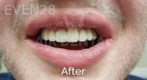 Jae-Lee-Teeth-Dental-Implants-after-4