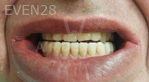 Jae-Lee-Teeth-Dental-Implants-after-5