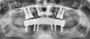 Jae-Lee-Teeth-Dental-Implants-after-5b