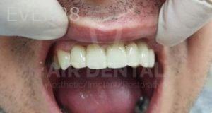 Jae-Lee-Teeth-Dental-Implants-after-6