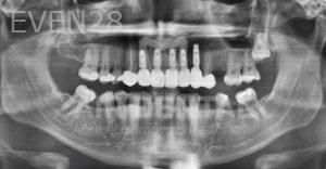 Jae-Lee-Teeth-Dental-Implants-after-6b