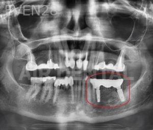 Jae-Lee-Teeth-Dental-Implants-after-7