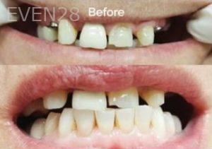 Jae-Lee-Teeth-Dental-Implants-before-3