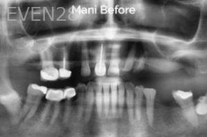 Jae-Lee-Teeth-Dental-Implants-before-3b