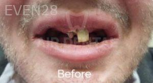 Jae-Lee-Teeth-Dental-Implants-before-4