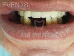 Jae-Lee-Teeth-Dental-Implants-before-5