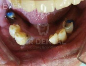 Jae-Lee-Teeth-Dental-Implants-before-5b