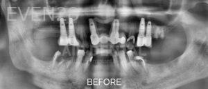 Jae-Lee-Teeth-Dental-Implants-before-5c