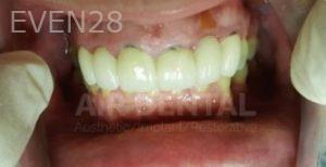 Jae-Lee-Teeth-Dental-Implants-before-6