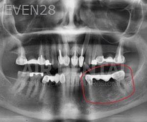 Jae-Lee-Teeth-Dental-Implants-before-7
