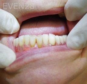 Jae-Lee-Teeth-Partial-Dentures-after-1
